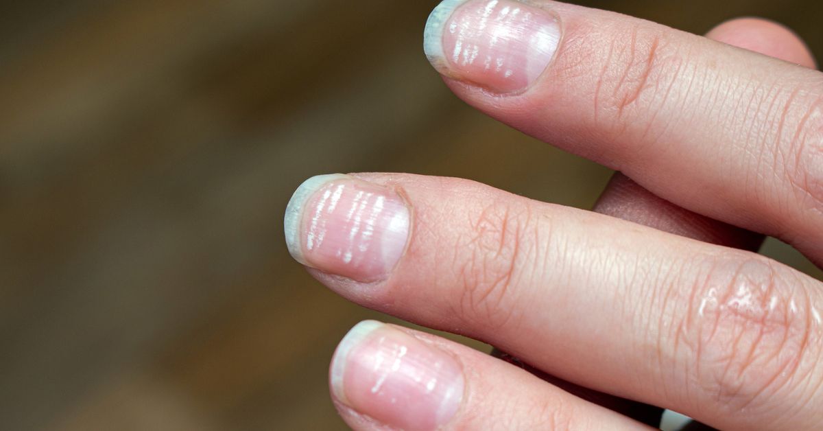 The Ultimate Guide on How to Fix a Damaged Nail Bed